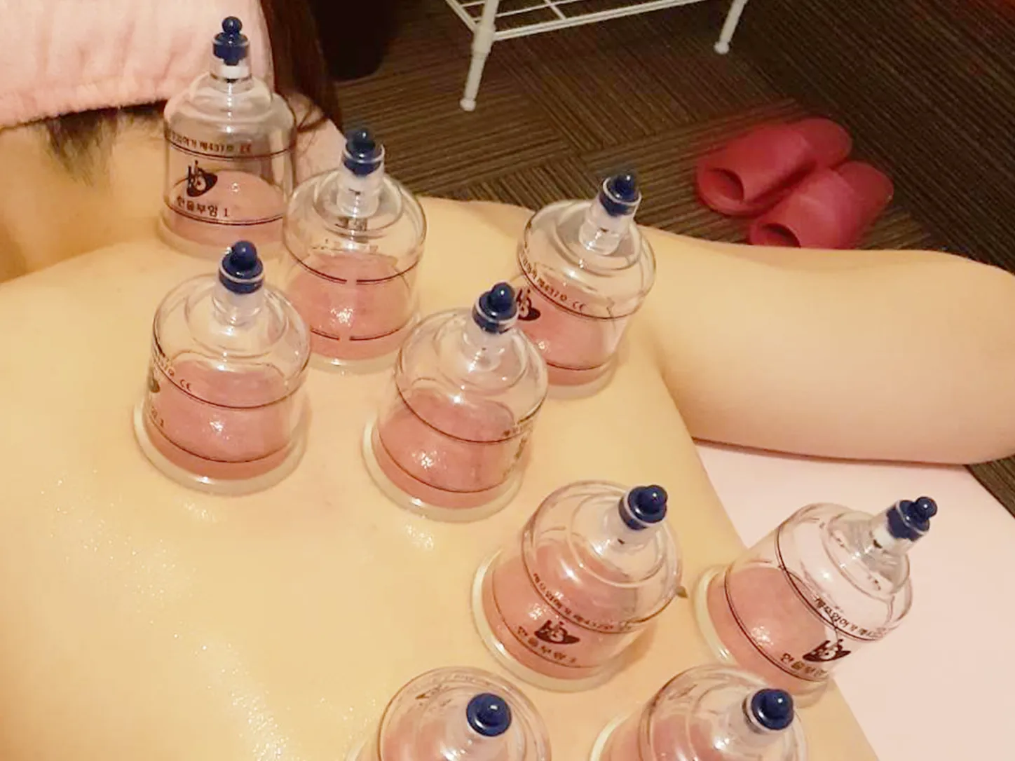 伊万里のCaraで背中に吸い玉カッピングを行っている施術風景